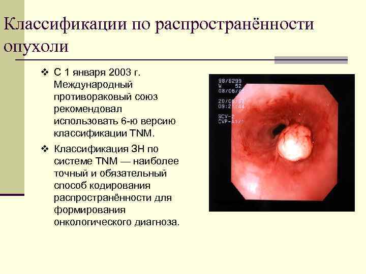 Классификации по распространённости опухоли v С 1 января 2003 г. Международный противораковый союз рекомендовал