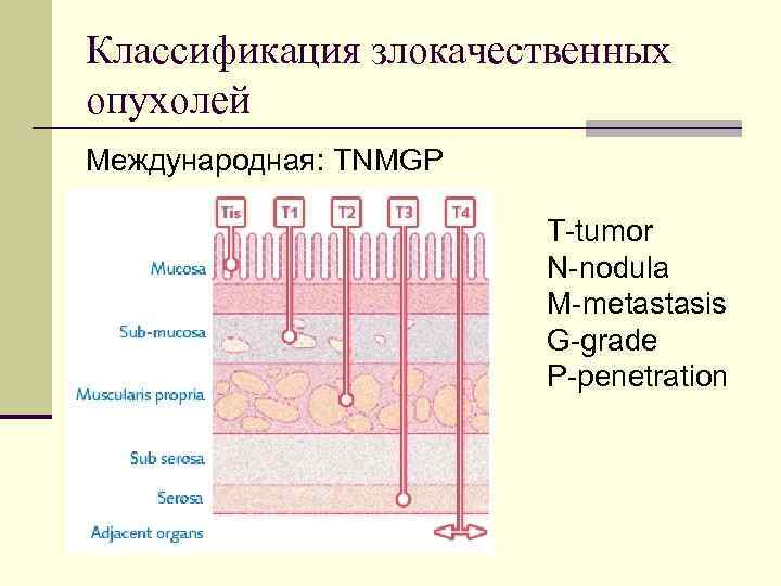 Классификация злокачественных опухолей Международная: TNMGP T-tumor N-nodula M-metastasis G-grade P-penetration 