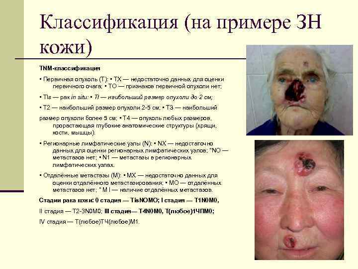 Классификация (на примере ЗН кожи) TNM-классификация • Первичная опухоль (Т): • ТХ — недостаточно