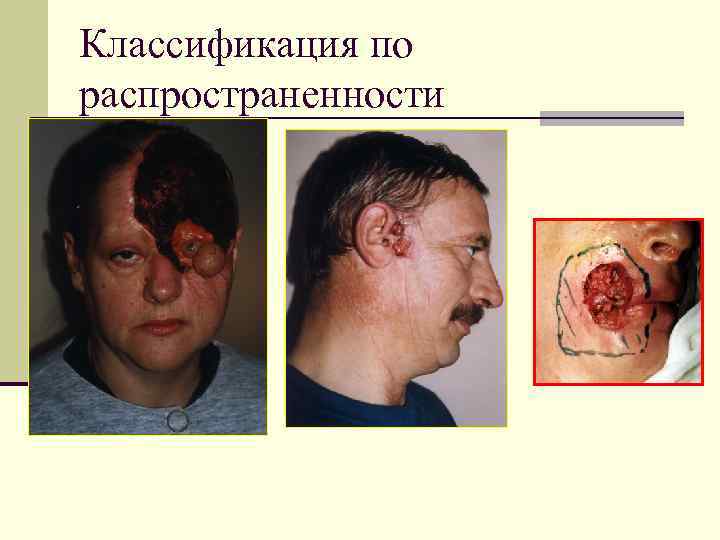 Классификация по распространенности 