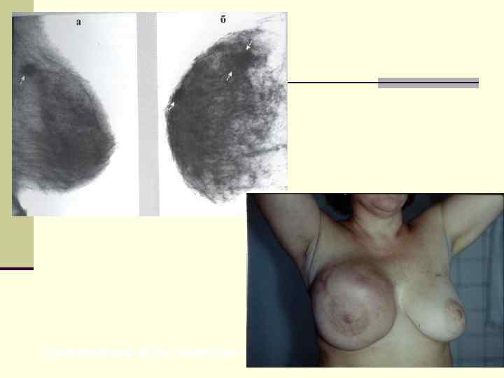 Синхронный мультицентрический рак молочных желез 