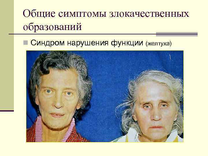 Общие симптомы злокачественных образований Синдром нарушения функции (желтуха) 