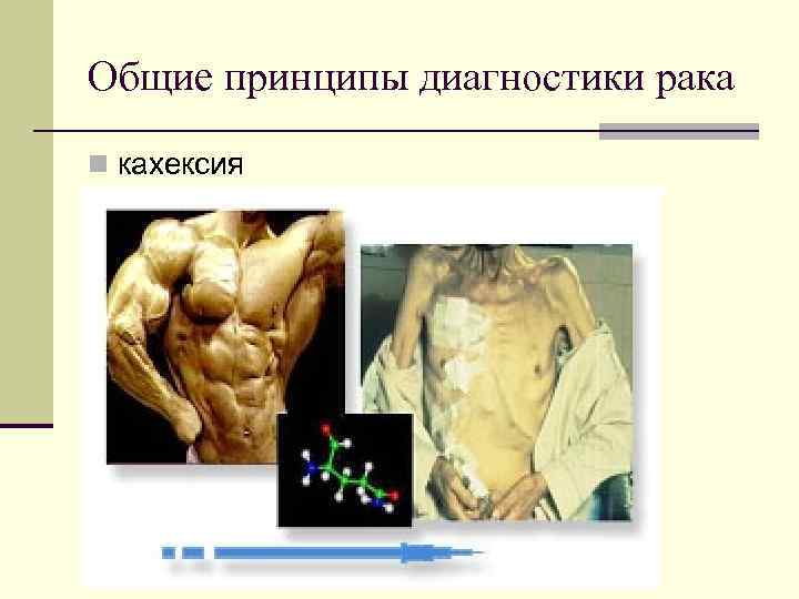 Общие принципы диагностики рака кахексия 