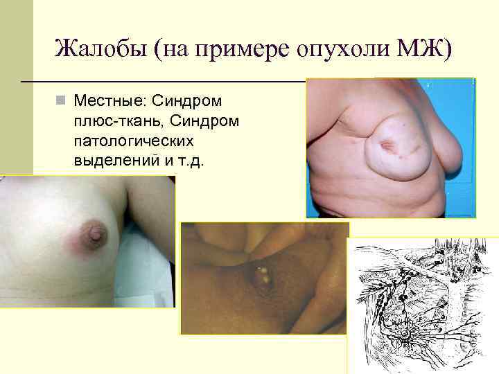 Жалобы (на примере опухоли МЖ) Местные: Синдром плюс-ткань, Синдром патологических выделений и т. д.