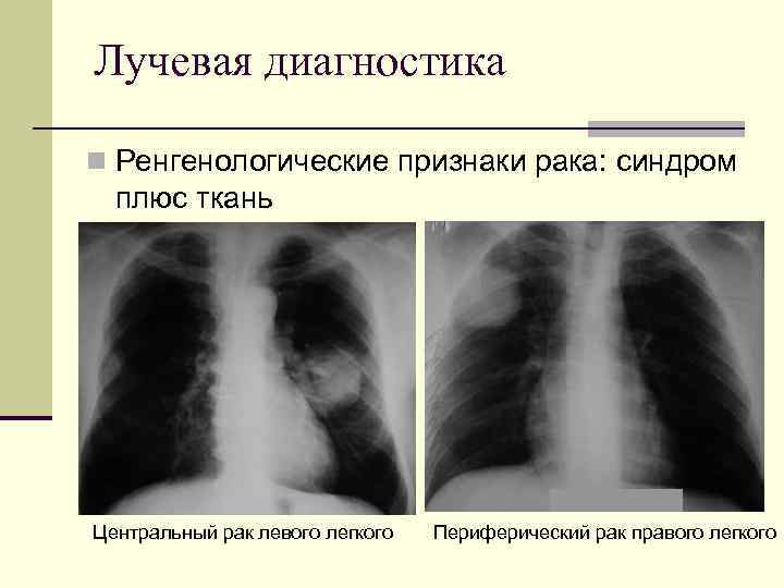 Лучевая диагностика Ренгенологические признаки рака: синдром плюс ткань Центральный рак левого легкого Периферический рак