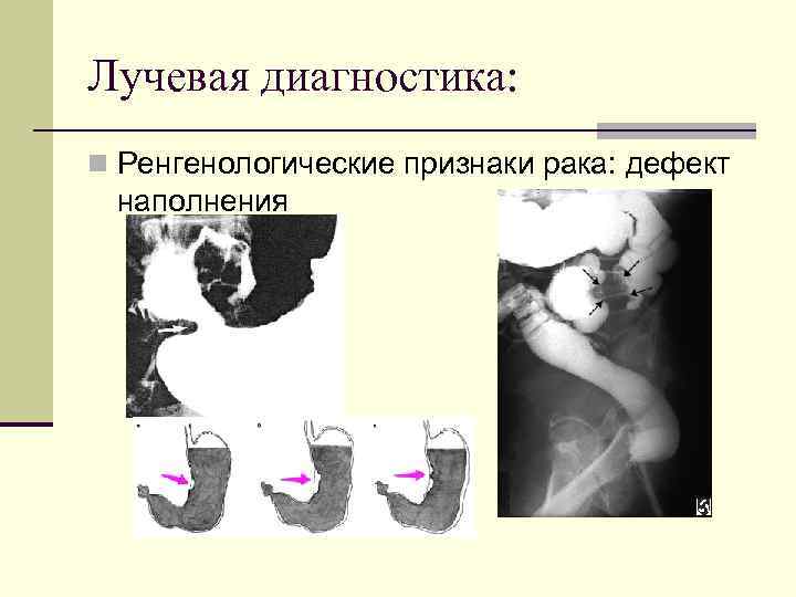 Лучевая диагностика: Ренгенологические признаки рака: дефект наполнения 
