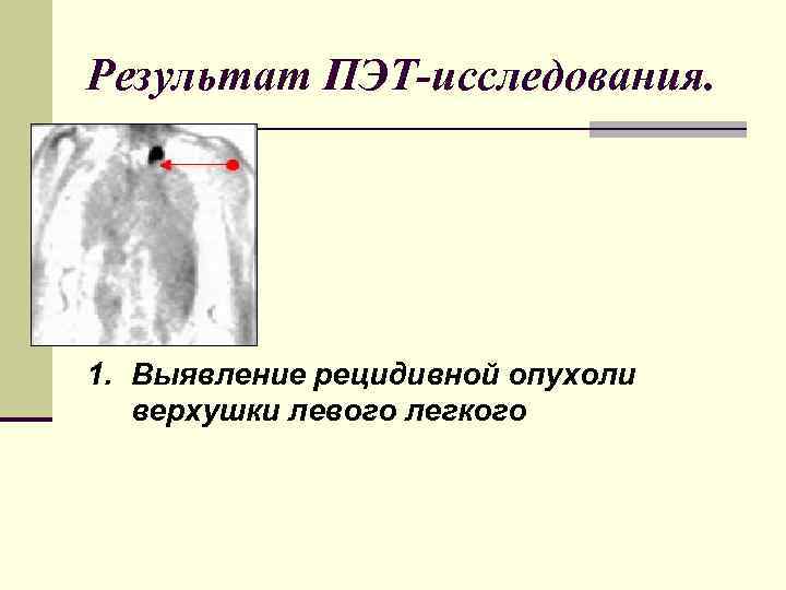 Результат ПЭТ-исследования. 1. Выявление рецидивной опухоли верхушки левого легкого 