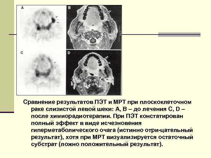 Сравнение результатов ПЭТ и МРТ при плоскоклеточном раке слизистой левой шеки: A, B –