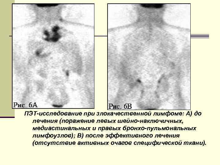 ПЭТ-исследование при злокачественной лимфоме: А) до лечения (поражение левых шейно-наключичных, медиастинальных и правых бронхо-пульмональных