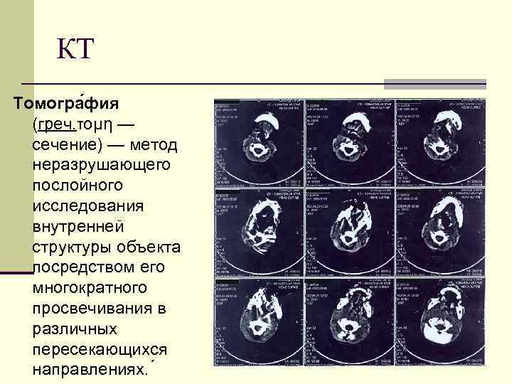 КТ Томогра фия (греч. τομη — сечение) — метод неразрушающего послойного исследования внутренней структуры