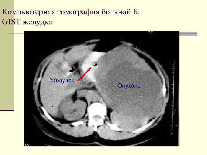 Кт желудка