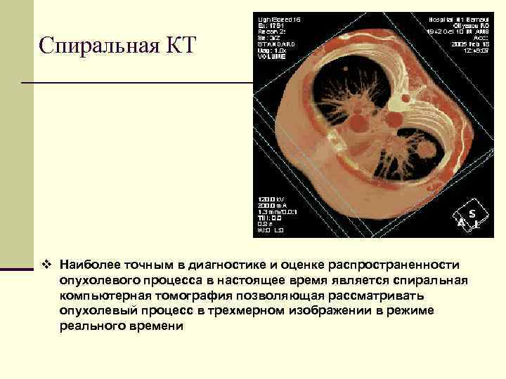 Спиральная КТ v Наиболее точным в диагностике и оценке распространенности опухолевого процесса в настоящее