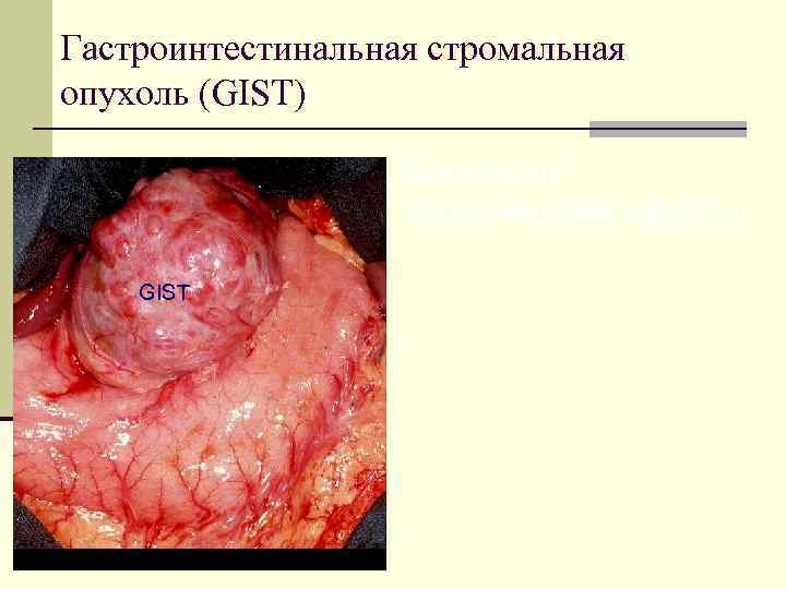 Гастроинтестинальная стромальная опухоль (GIST) Критерии злокачественности: GIST 