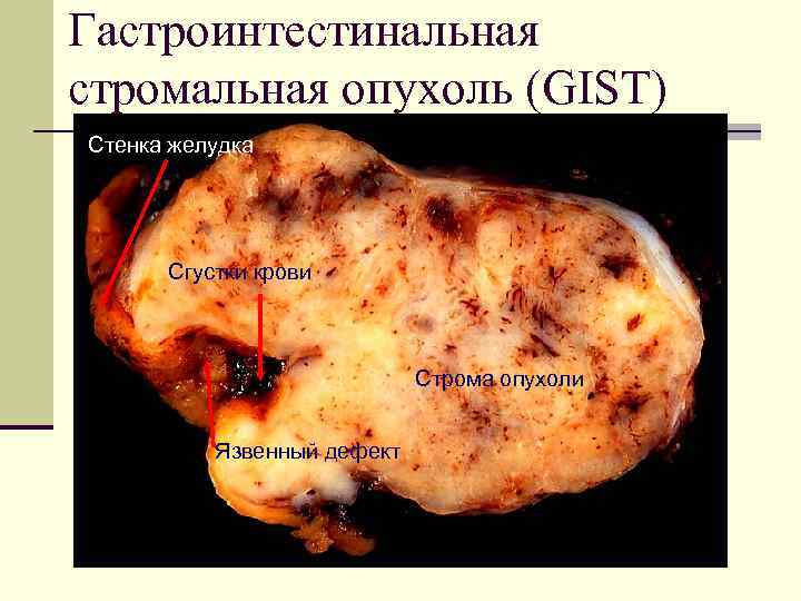 Гастроинтестинальная стромальная опухоль (GIST) Стенка желудка Сгустки крови Строма опухоли Язвенный дефект 