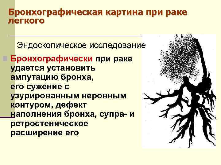 Бронхографическая картина при раке легкого Эндоскопическое исследование Бронхографически при раке удается установить ампутацию бронха,