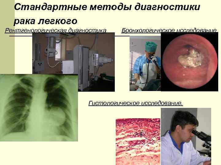 Стандартные методы диагностики рака легкого Рентгенологическая диагностика Бронхологическое исследование Гистологическое исследование. 