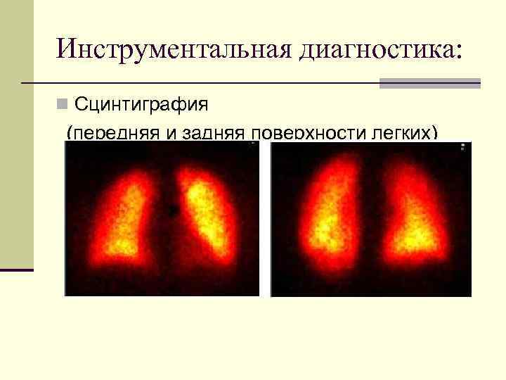 Инструментальная диагностика: Сцинтиграфия (передняя и задняя поверхности легких) 