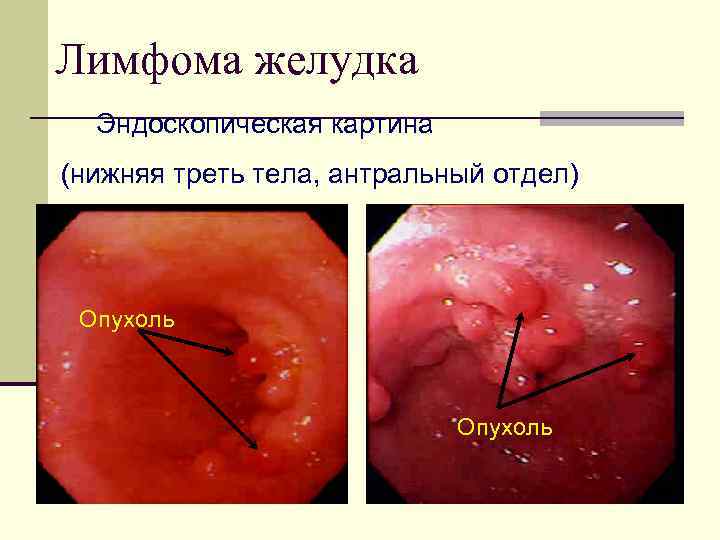 Лимфома желудка Эндоскопическая картина (нижняя треть тела, антральный отдел) Опухоль 
