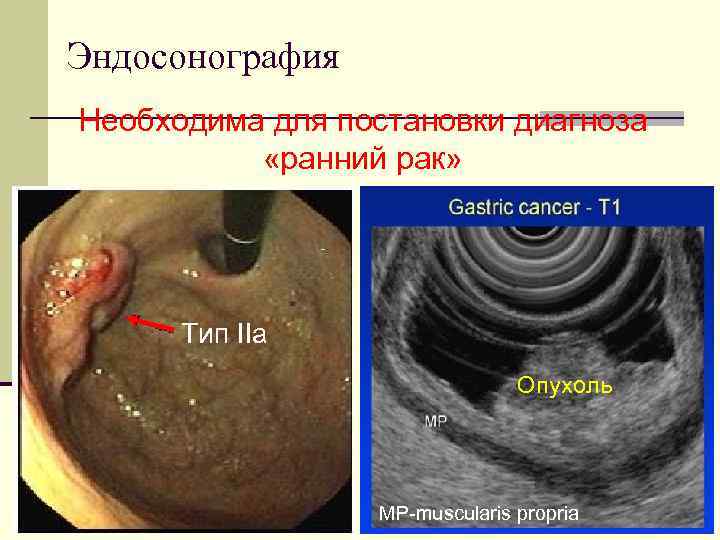 Эндосонография Необходима для постановки диагноза «ранний рак» Тип IIa Опухоль MP-muscularis propria 