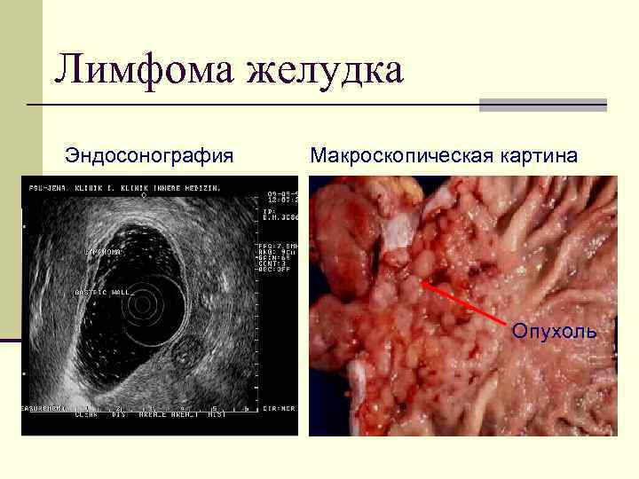 Лимфома желудка Эндосонография Макроскопическая картина Опухоль 