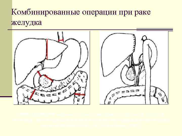 Рак желудка операция. Комбинированные операции примеры. Комбинированная операция пример. Сочетанные и комбинированные операции.