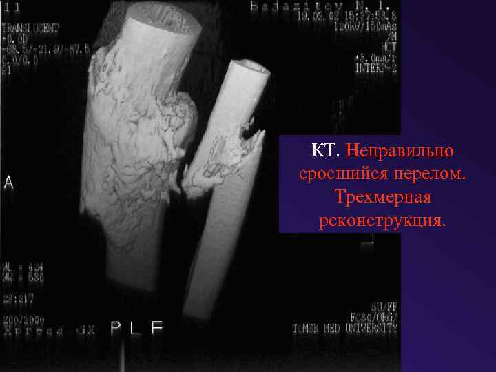КТ. Неправильно сросшийся перелом. Трехмерная реконструкция. 
