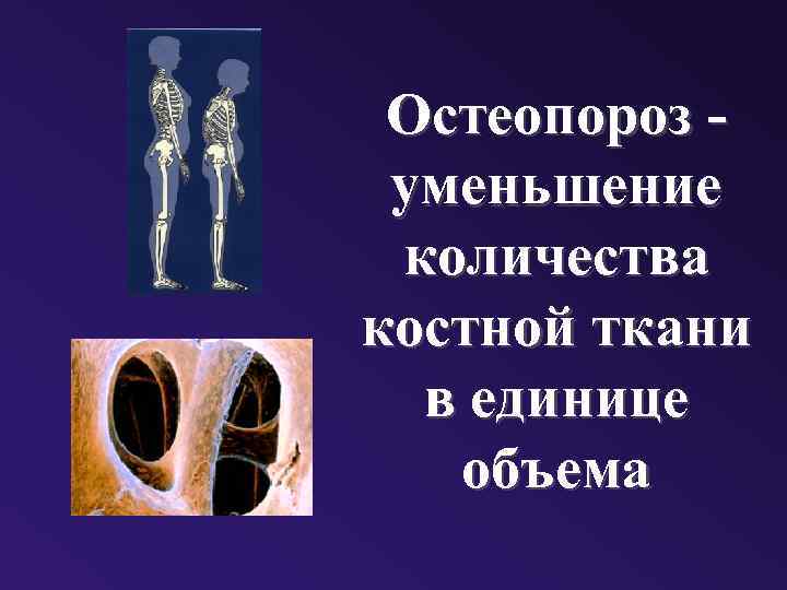 Остеопороз уменьшение количества костной ткани в единице объема 