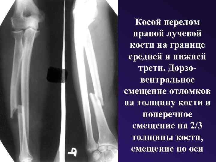 Косой перелом правой лучевой кости на границе средней и нижней трети. Дорзовентральное смещение отломков