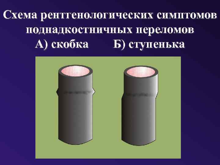 Схема рентгенологических симптомов поднадкостничных переломов А) скобка Б) ступенька 