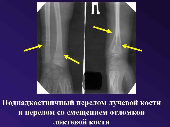 Поднадкостничный перелом лучевой кости и перелом со смещением отломков локтевой кости 