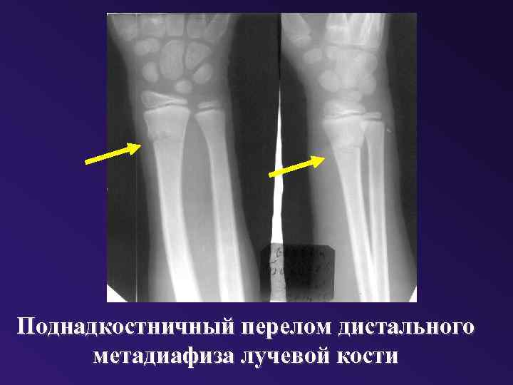 Перелом луча в типичном месте презентация