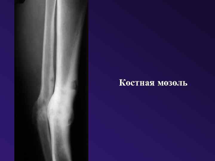 Костная мозоль 