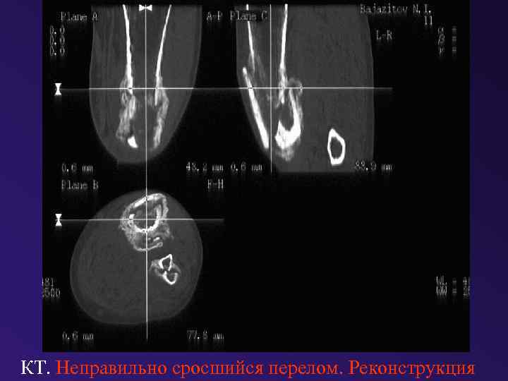КТ. Неправильно сросшийся перелом. Реконструкция 
