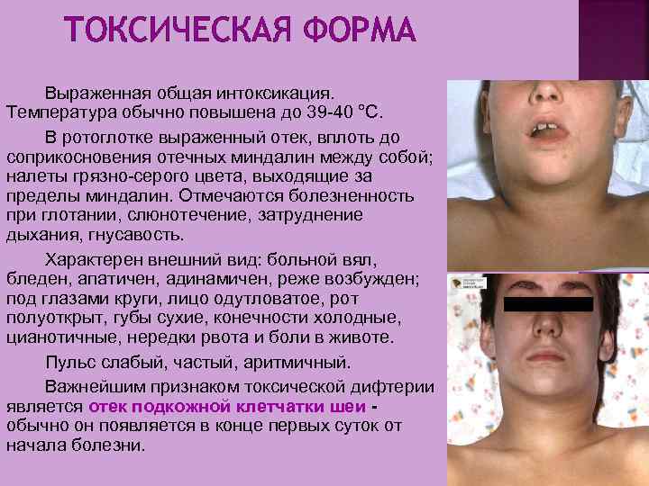 ТОКСИЧЕСКАЯ ФОРМА Выраженная общая интоксикация. Температура обычно повышена до 39 40 °С. В ротоглотке