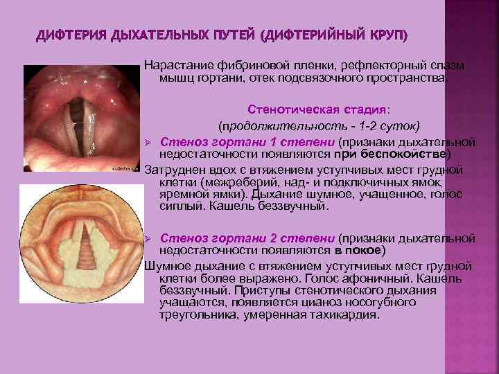 ДИФТЕРИЯ ДЫХАТЕЛЬНЫХ ПУТЕЙ (ДИФТЕРИЙНЫЙ КРУП) Нарастание фибриновой пленки, рефлекторный спазм мышц гортани, отек подсвязочного