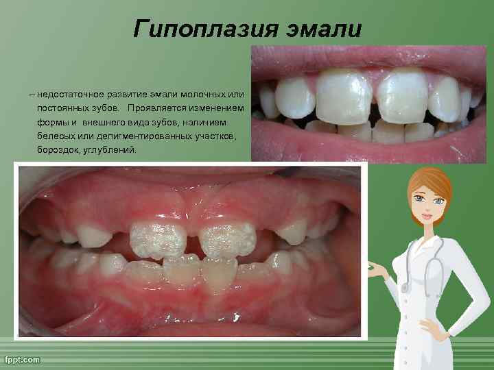 Гипоплазия эмали – недостаточное развитие эмали молочных или постоянных зубов. Проявляется изменением формы и