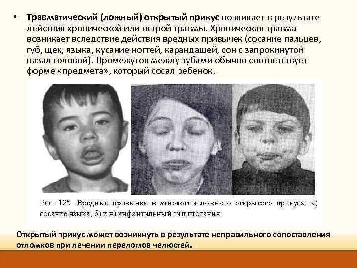  • Травматический (ложный) открытый прикус возникает в результате действия хронической или острой травмы.