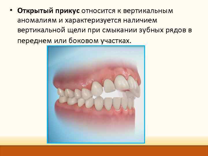  • Открытый прикус относится к вертикальным аномалиям и характеризуется наличием вертикальной щели при