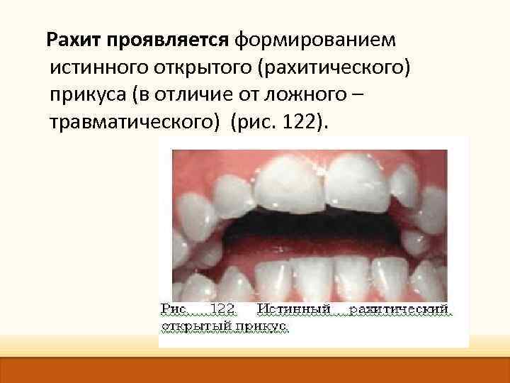  Рахит проявляется формированием истинного открытого (рахитического) прикуса (в отличие от ложного – травматического)