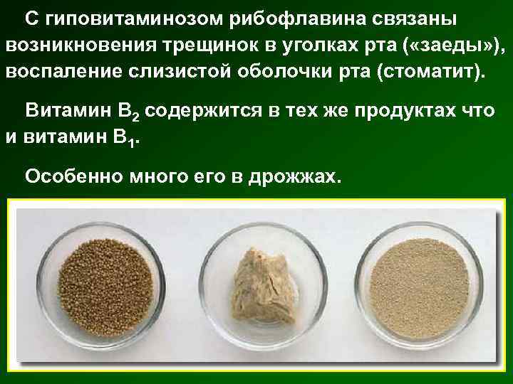 С гиповитаминозом рибофлавина связаны возникновения трещинок в уголках рта ( «заеды» ), воспаление слизистой