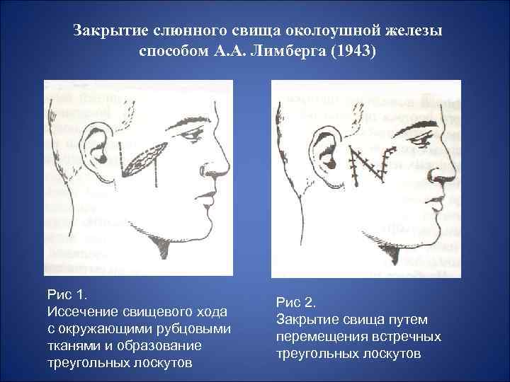 Закрытие слюнного свища околоушной железы способом А. А. Лимберга (1943) Рис 1. Иссечение свищевого