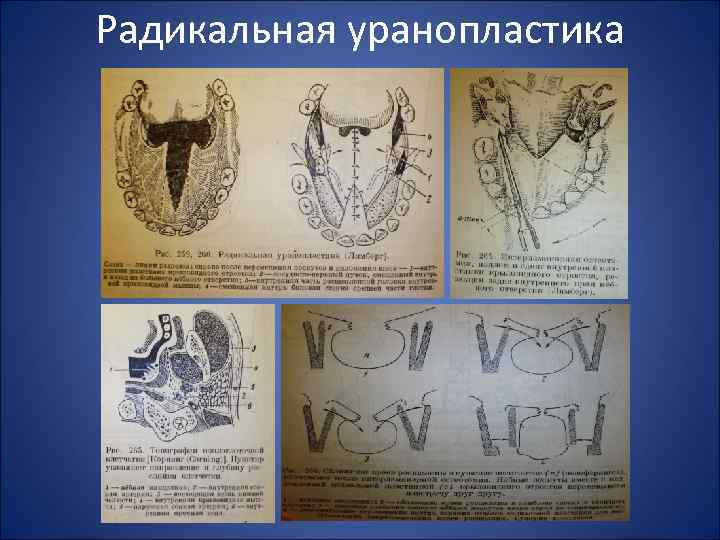 Радикальная уранопластика 