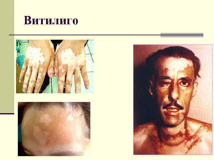 Витилиго 