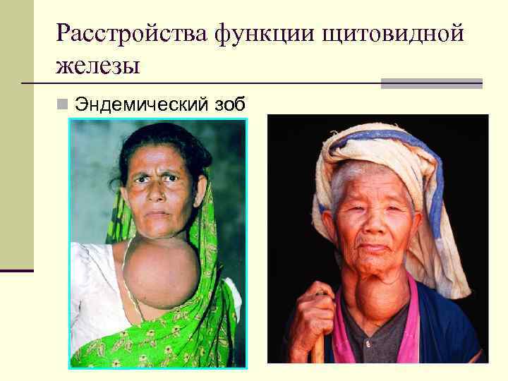 Расстройства функции щитовидной железы n Эндемический зоб 