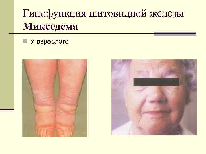 Гипофункция щитовидной железы Микседема n У взрослого 