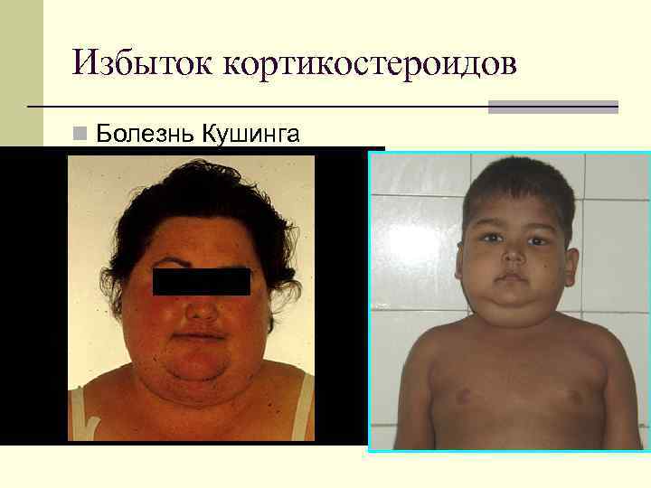 Избыток кортикостероидов n Болезнь Кушинга 