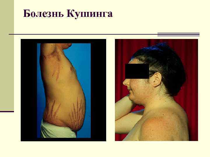 Болезнь Кушинга 