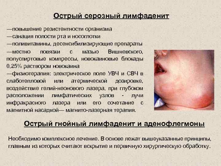 Острый серозный лимфаденит ―повышение резистентности организма ―санация полости рта и носоглотки ―поливитамины, десенсибилизирующие препараты