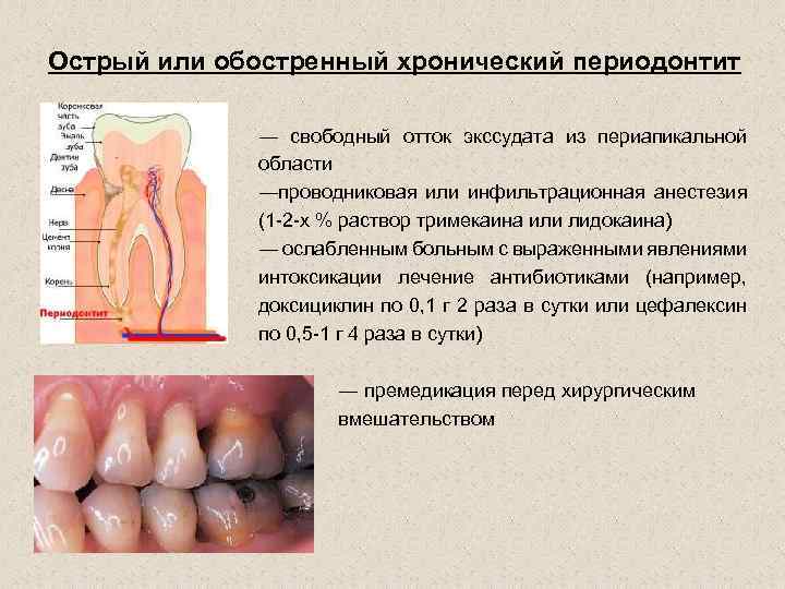 Острый или обостренный хронический периодонтит ― свободный отток экссудата из периапикальной области ―проводниковая или