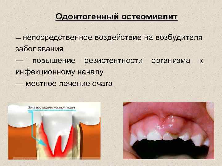 Одонтогенный остеомиелит непосредственное воздействие на возбудителя заболевания ― повышение резистентности организма к инфекционному началу